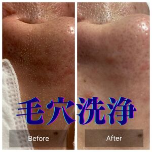 毛穴洗浄