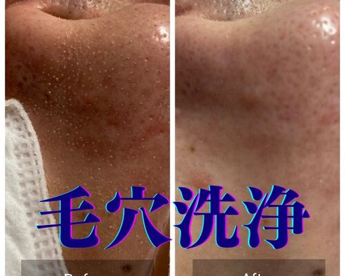 毛穴洗浄