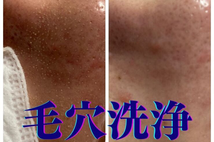 毛穴洗浄