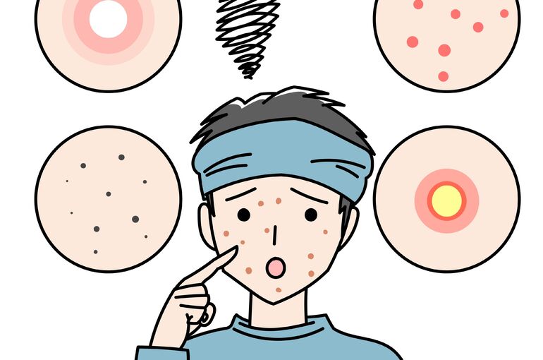 大人ニキビ